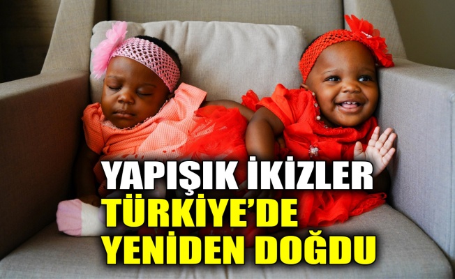 Yapışık ikizler Türkiye’de yeniden doğdu