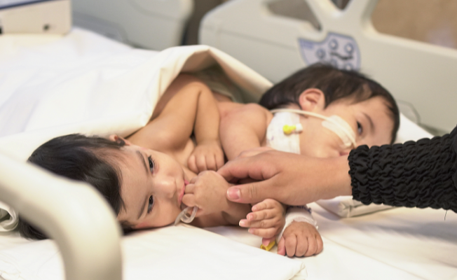 Cezayirli yapışık ikizler Türkiye’de 9 saat süren bir operasyonla kendi bedenlerine kavuştular