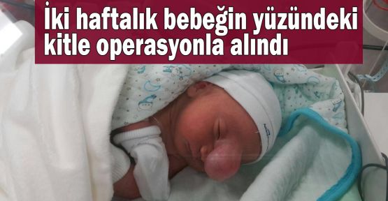 İki haftalık bebeğin yüzündeki kitle operasyonla alındı