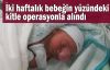 İki haftalık bebeğin yüzündeki kitle operasyonla alındı
